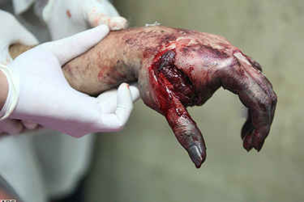 6 مصدوم حاصل حوادث چهارشنبه سوری در خراسان &zwnj;شمالی